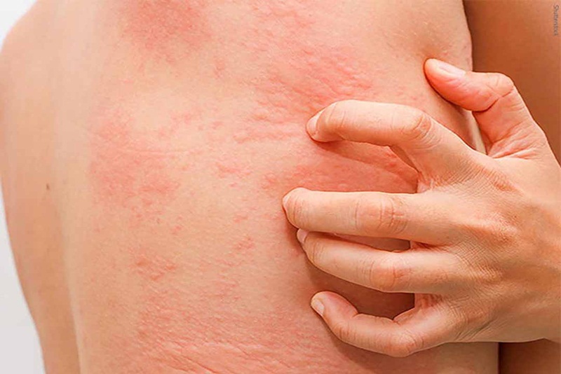 Người bệnh cảm thấy ngứa ngáy khó chịu với những cục nổi mẩn đỏ trên da